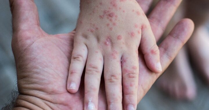 Infectólogos llaman a la calma tras confirmación de casos de viruela símica