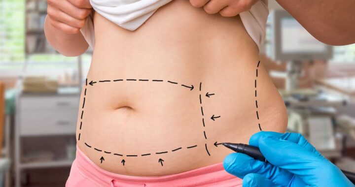 Muere mujer tras liposucción; investigan a supuesto responsable y clínica donde fue operada